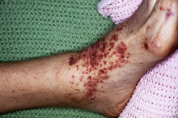 photo of typhoid rash on foot