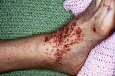 Some people with typhoid fever get a flat rash called rose spots. In people with a light skin tone, the spots appear rose-colored or warm pink. (Photo Credit: Mike Devlin/Science Source)