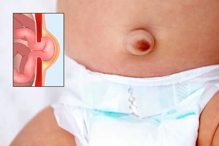 photo of baby girl with umbilical hernia