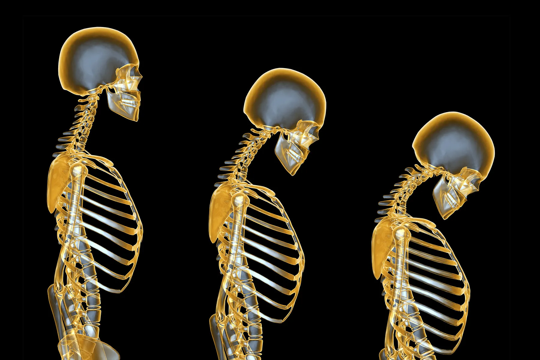 illustration of osteoporosis progression