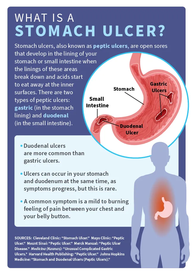 What is a Stomach Ulcer? infographic