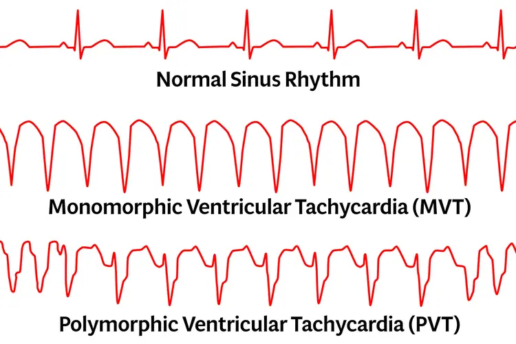 photo of ekg