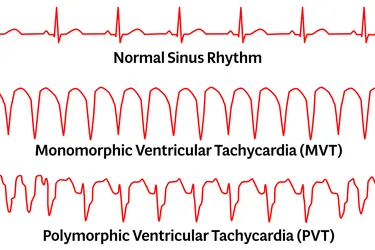 Ventricular tachycardia (VT) is a type of arrhythmia, or irregular heart rhythm. It’s an unusually fast heartbeat that starts in the lower part of your heart (the ventricles). Monomorphic VT describes when your heart rhythm looks more steady from beat to beat when your doctor checks the electrical activity with an electrocardiogram (EKG). Polymorphic VT is a very dangerous type of arrhythmia, when your heart’s electrical activity changes from beat to beat. (Photo credit: iStock/Getty Images)