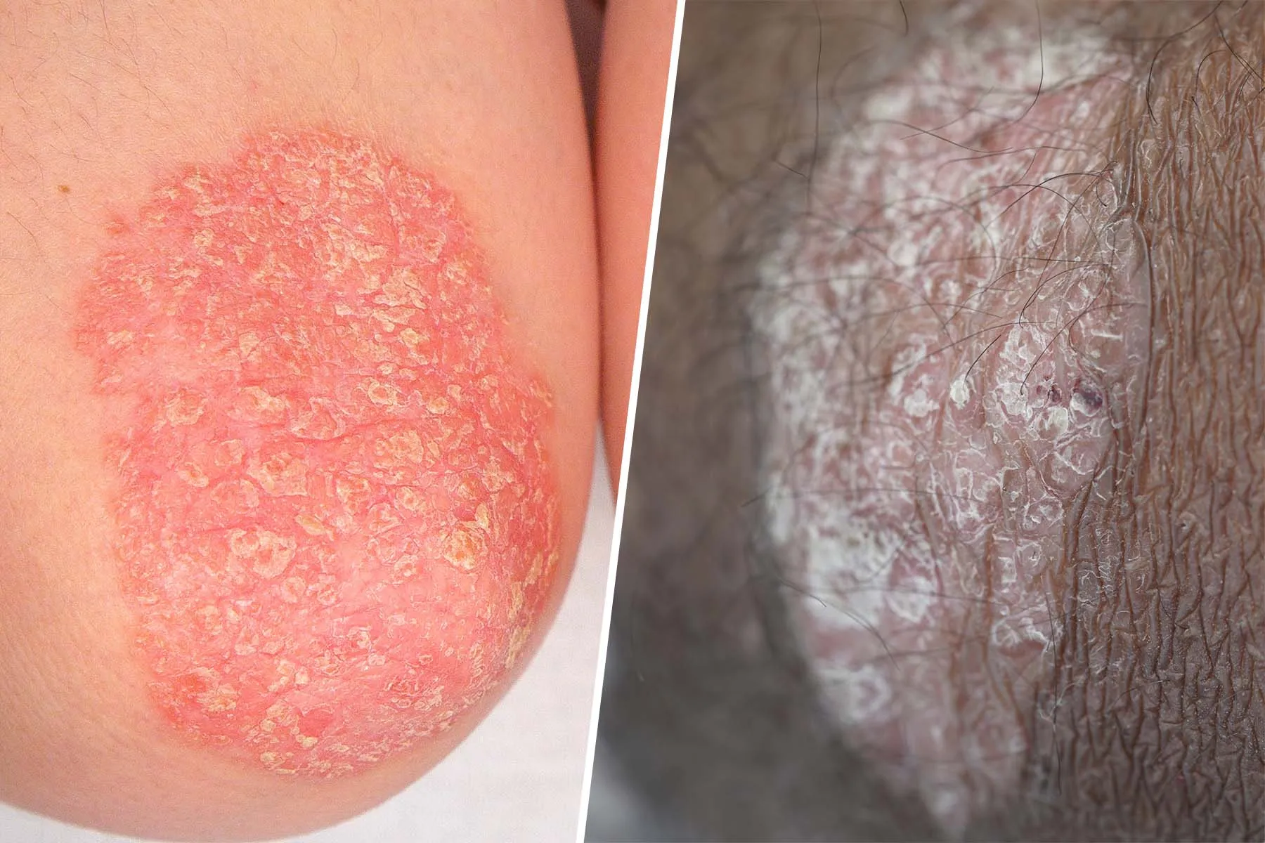 photo of psoriasis plaques