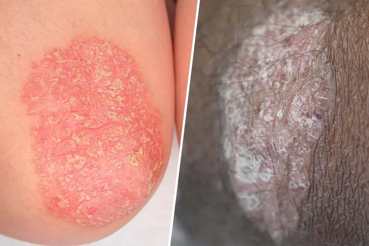 photo of psoriasis plaques