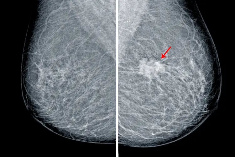 photo of MRI revealing breast calcifications