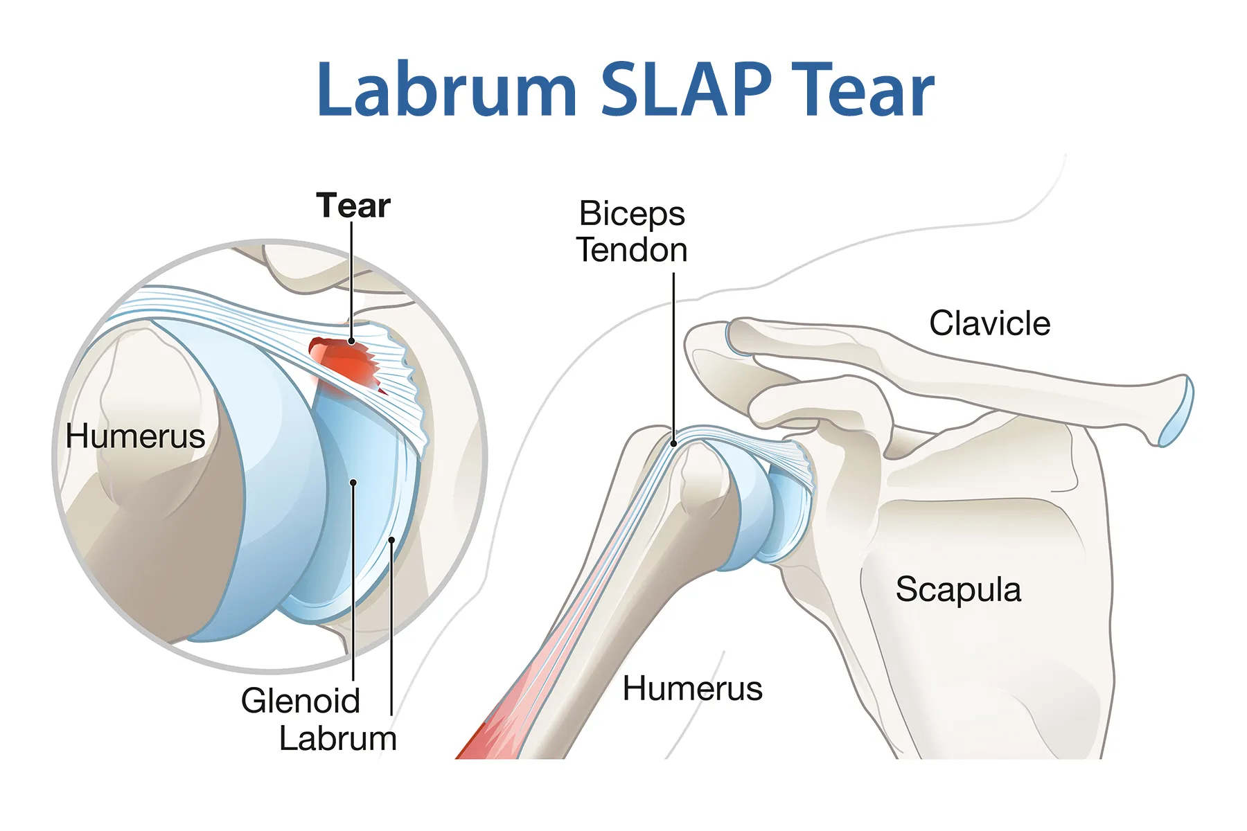 Labrum (Lb) is a ring of fibrocartilaginous tissue found in ball-and-socket joints, most notably the shoulder (glenoid labrum) and hip (acetabular labrum).