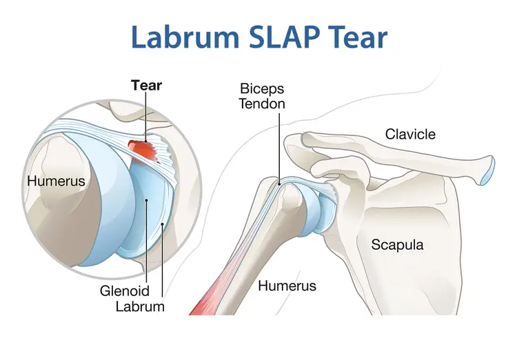 illustration of labrum SLAP tear