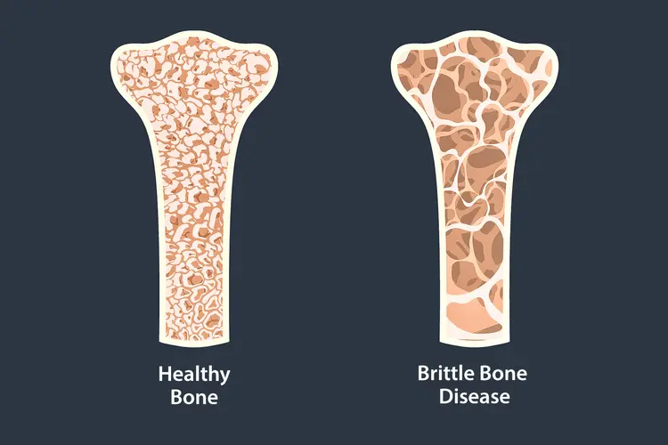 illustration of healthy bone vs. brittle bone disease