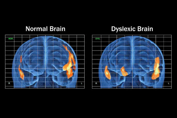 photo of dyslexic brain
