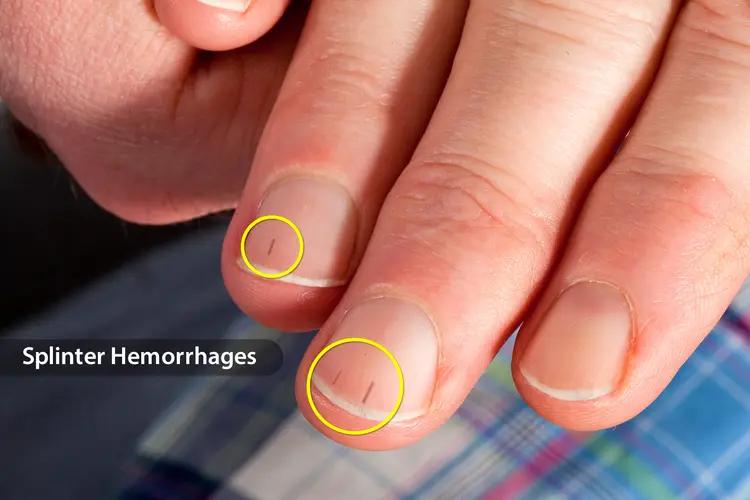 photo of splinter hemorrhages in man's fingernails
