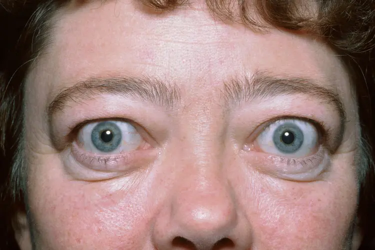 photo of thyroid eye disease