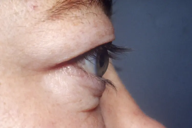 photo of thyroid eye disease