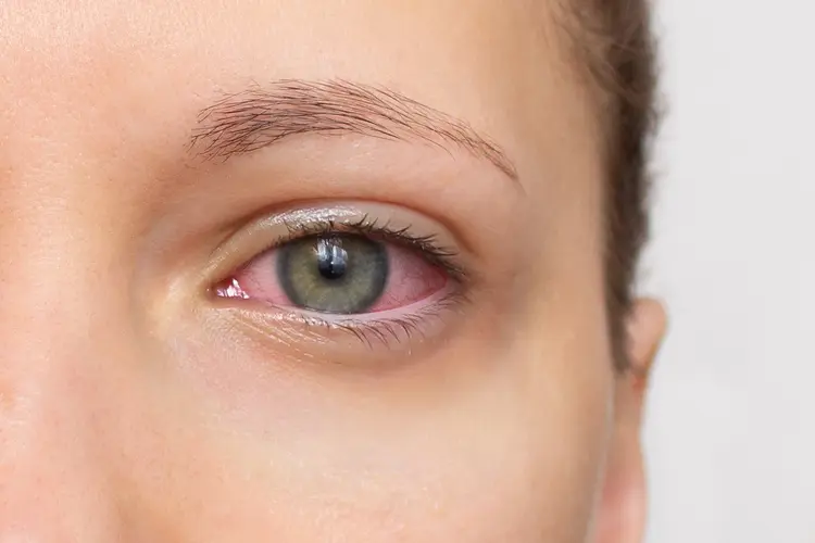 photo of uveitis