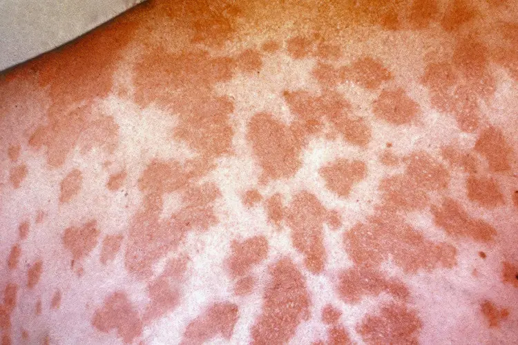 photo of Erythema nodosum / Valley Fever