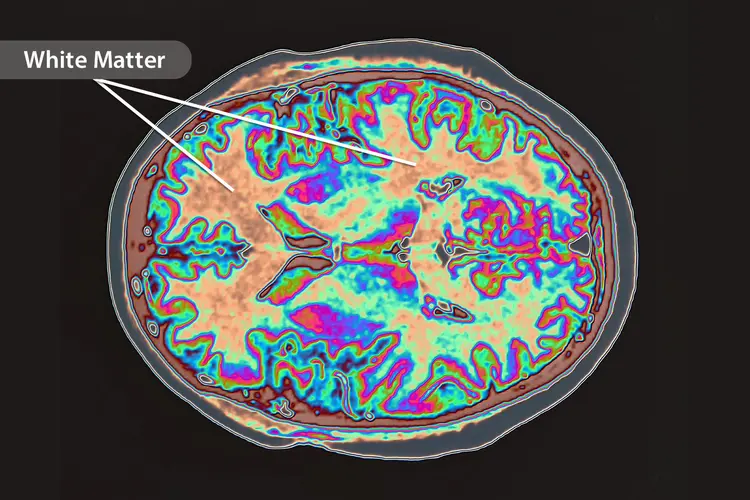 photo of MRI brain scan revealing white matter