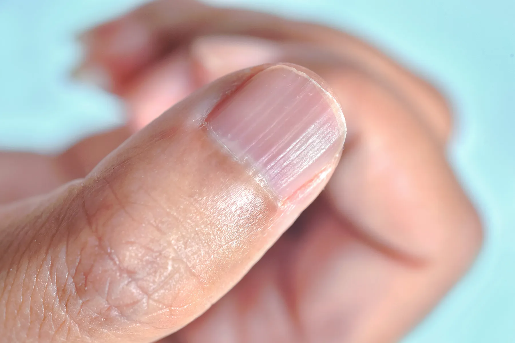 Onychorrhexis: Causes, Symptoms, and Treatment