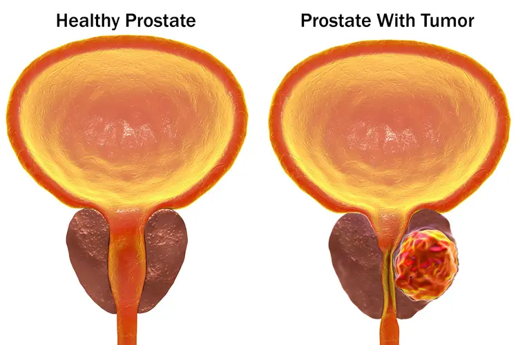 photo of healthy prostate vs unhealthy prostate