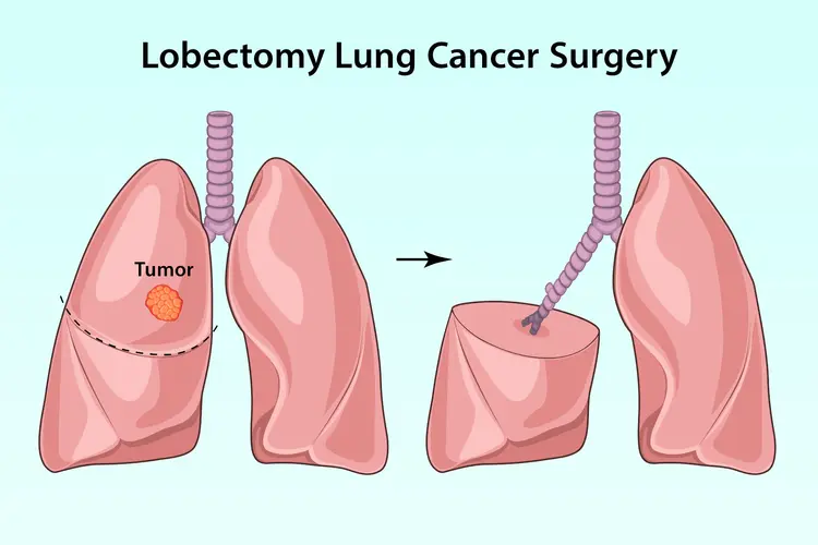illustration of lobectomy lung cancer surgery