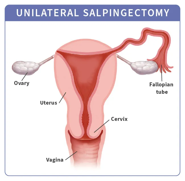 unilateral salpingectomy infographic
