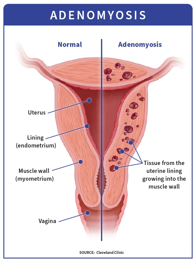 Adenomyosis infographic