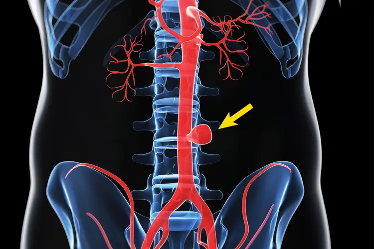 photo of saccular aortic aneurysm
