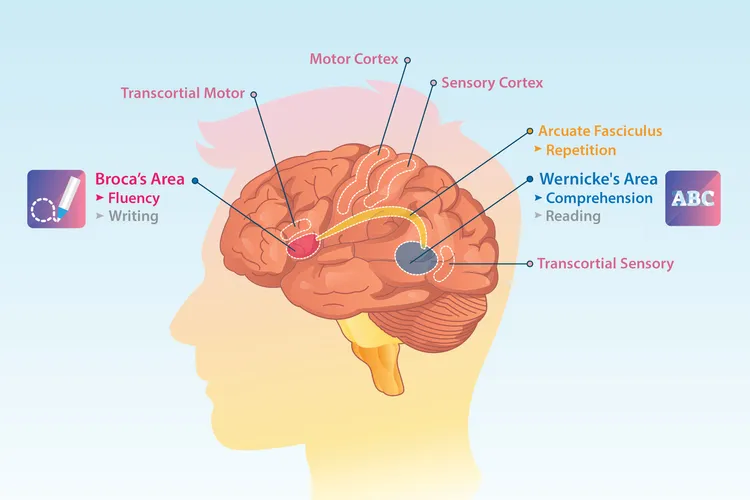 photo of aphasia brain anatomy