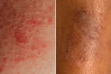 What an eczema rash looks like will vary depending on the color of your skin. (Photo Credit: Moment / Getty Images, SCIENCE PHOTO LIBRARY / Science Source)