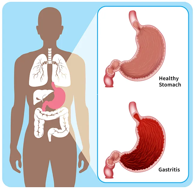 Healthy Stomach vs. Gastritis infographic