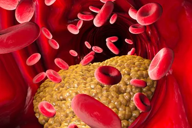 When you have hyperlipidemia, you have too many lipids in your blood. That can clog your arteries, raising your risk of having a stroke and heart problems. (Photo Credit: iStock/Getty Images)