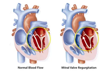 Mitral valve regurgitation is when your blood isn’t going where it should. With this condition, some of it leaks backward instead of flowing out to the rest of your body.  You may feel tired and out of breath if you have it. You may also have higher blood pressure and a buildup of fluid in your lungs. (Photo credit: BSIP/Jacopin/Medical Images)
