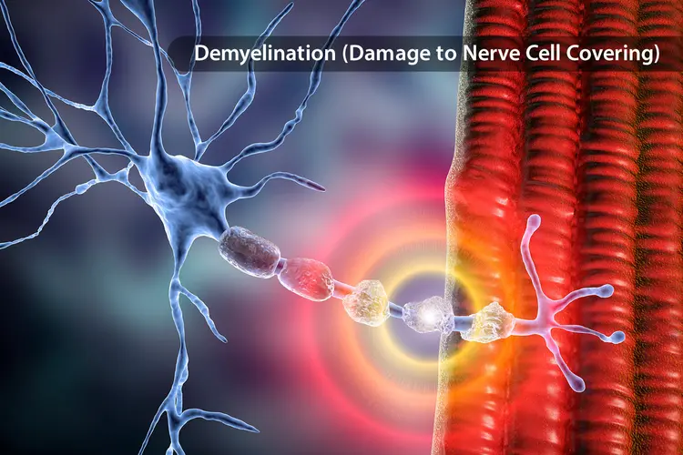 photo of demyelination of nerve cell covering