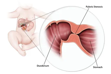 Pyloric stenosis, also known as infantile hypertrophic pyloric stenosis, is a rare condition that makes the valve between a newborn's stomach and small intestine get thick and swollen, blocking food from traveling from the baby's stomach into the intestine. (Photo credit: MAURIZIO DE ANGELIS/Science Source)