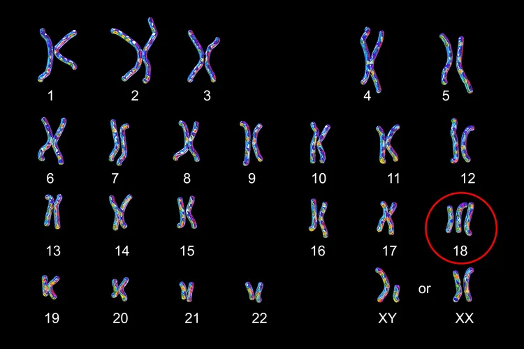photo of chromosomes revealing Trisomy 18