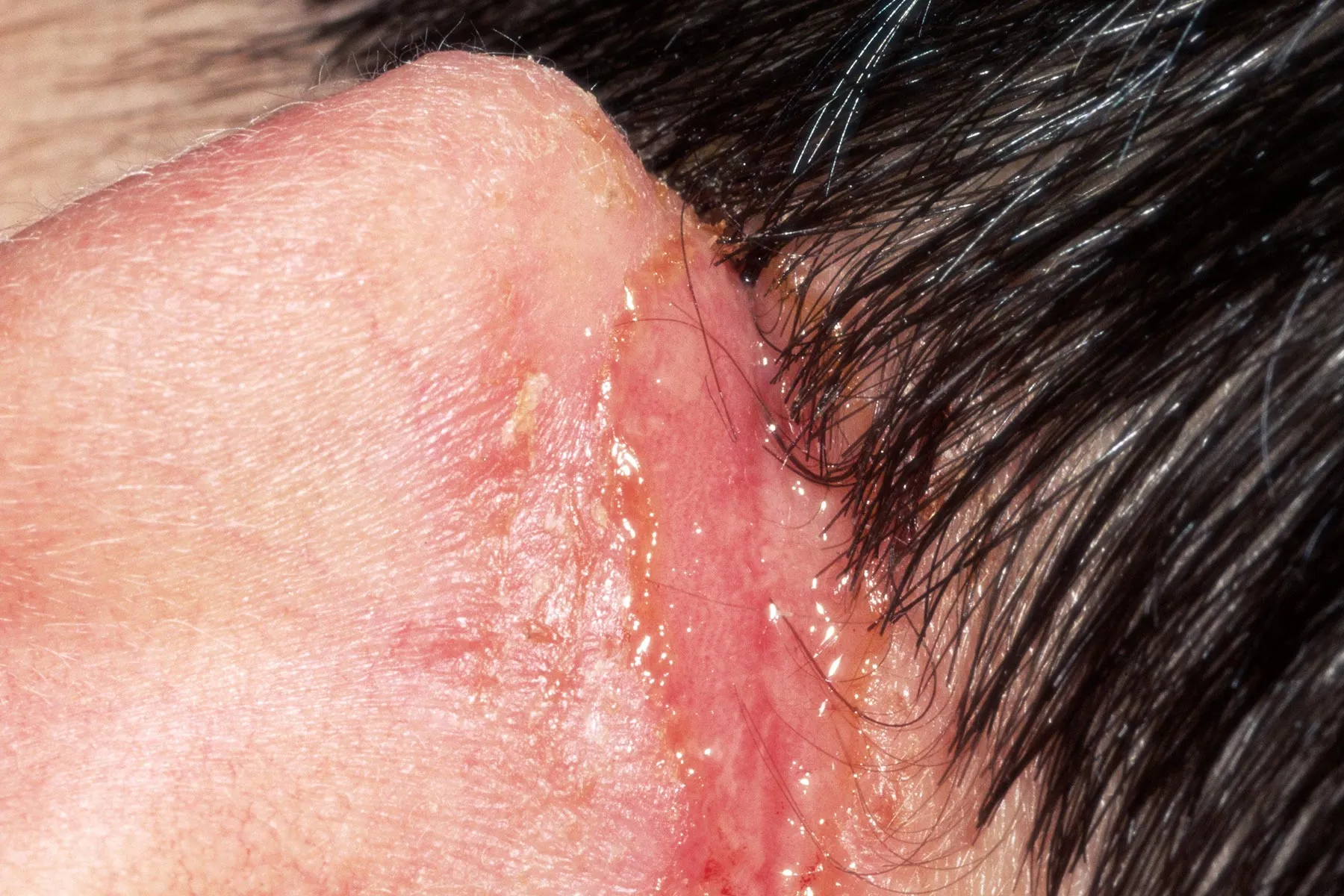 photo of weeping eczema on ear