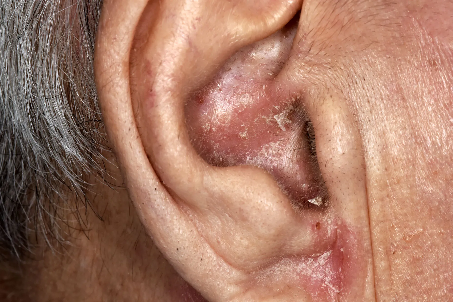 photo of eczema in ear