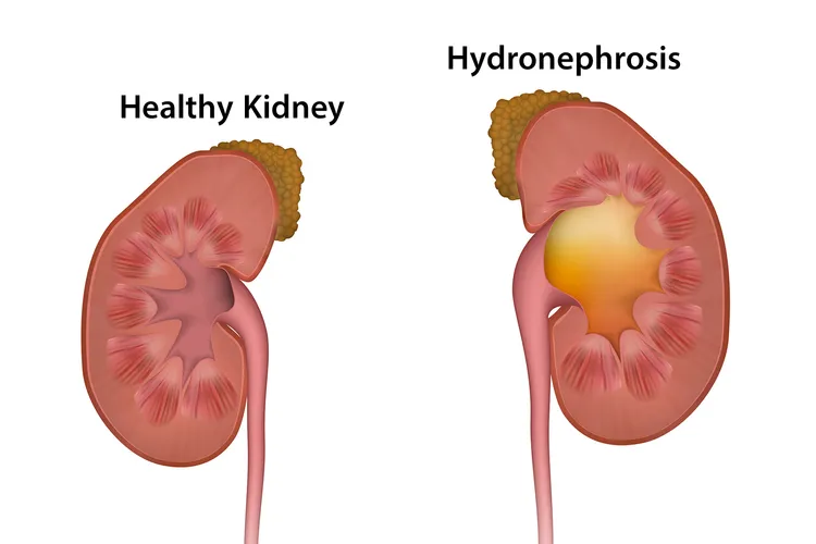 illustration of renal hydronephrosis