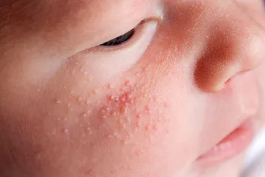 Milia are tiny, hard, white bumps that appear on your skin. Anyone can get them on any part of the body, but they most often happen on infants’ faces. They are harmless and painless and usually disappear on their own after a few weeks. (Photo credit: iStock/Getty Images)