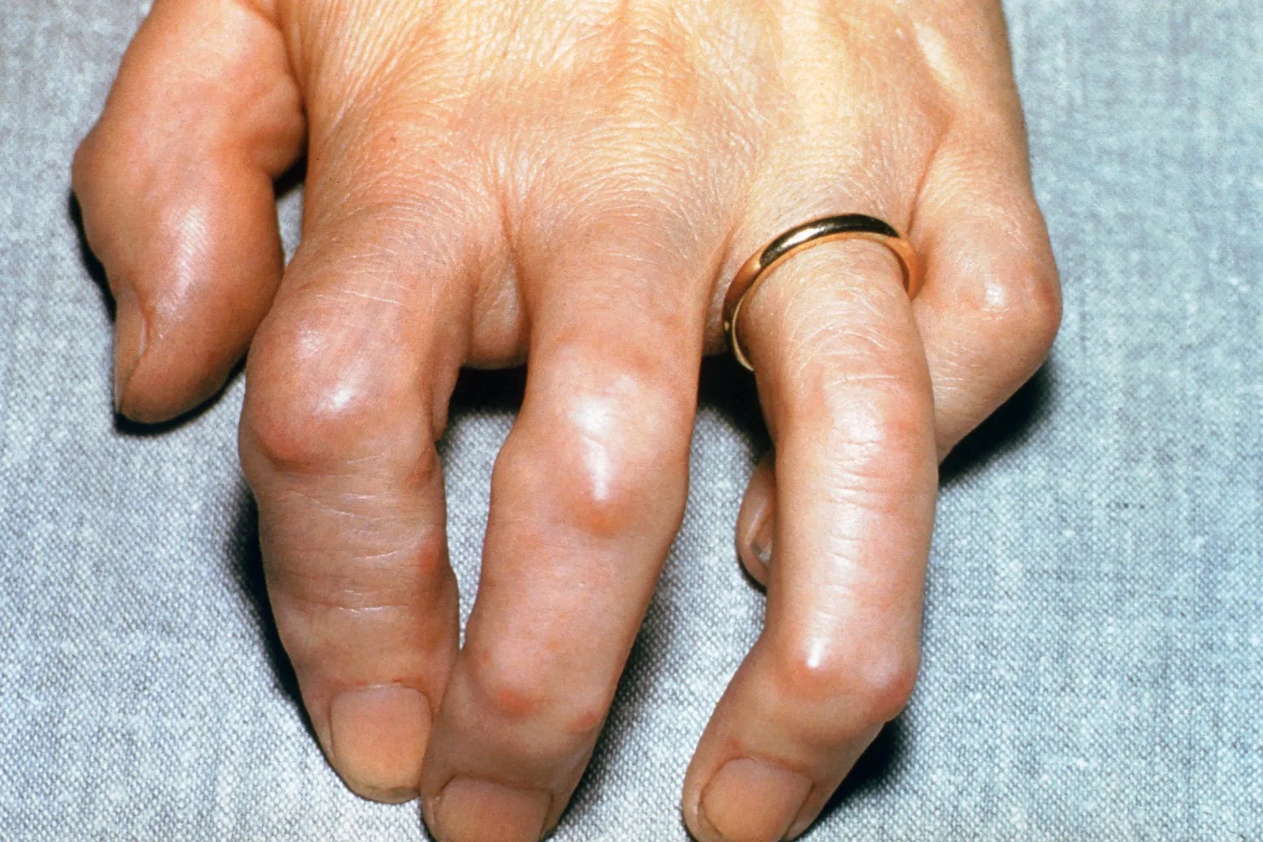 photo of hand displaying rheumatoid arthritis