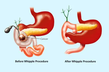 The Whipple procedure involves removal of the head of the pancreas, which is connected to the top part of the small intestine. Surgeons reconnect the small intestine, bile duct, and pancreas after they remove tumors or other damaged tissue. (Photo credit: iStock/Getty Images)