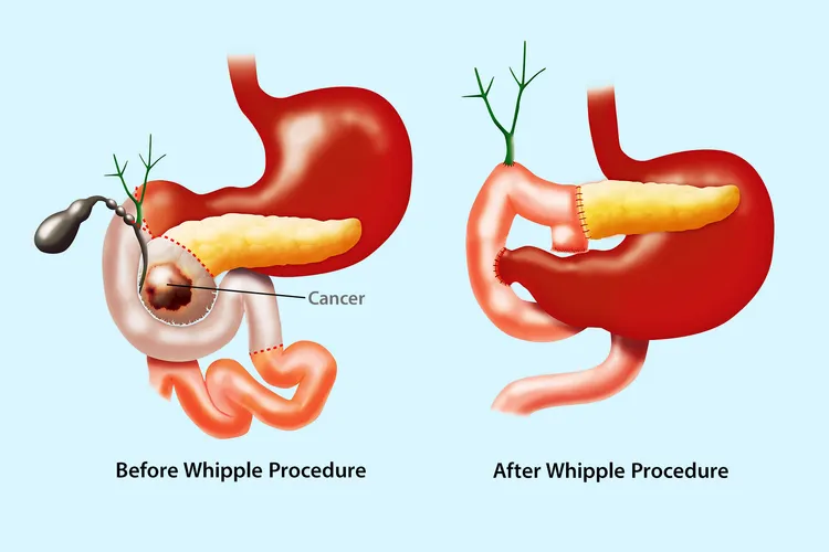 photo of Whipple procedure