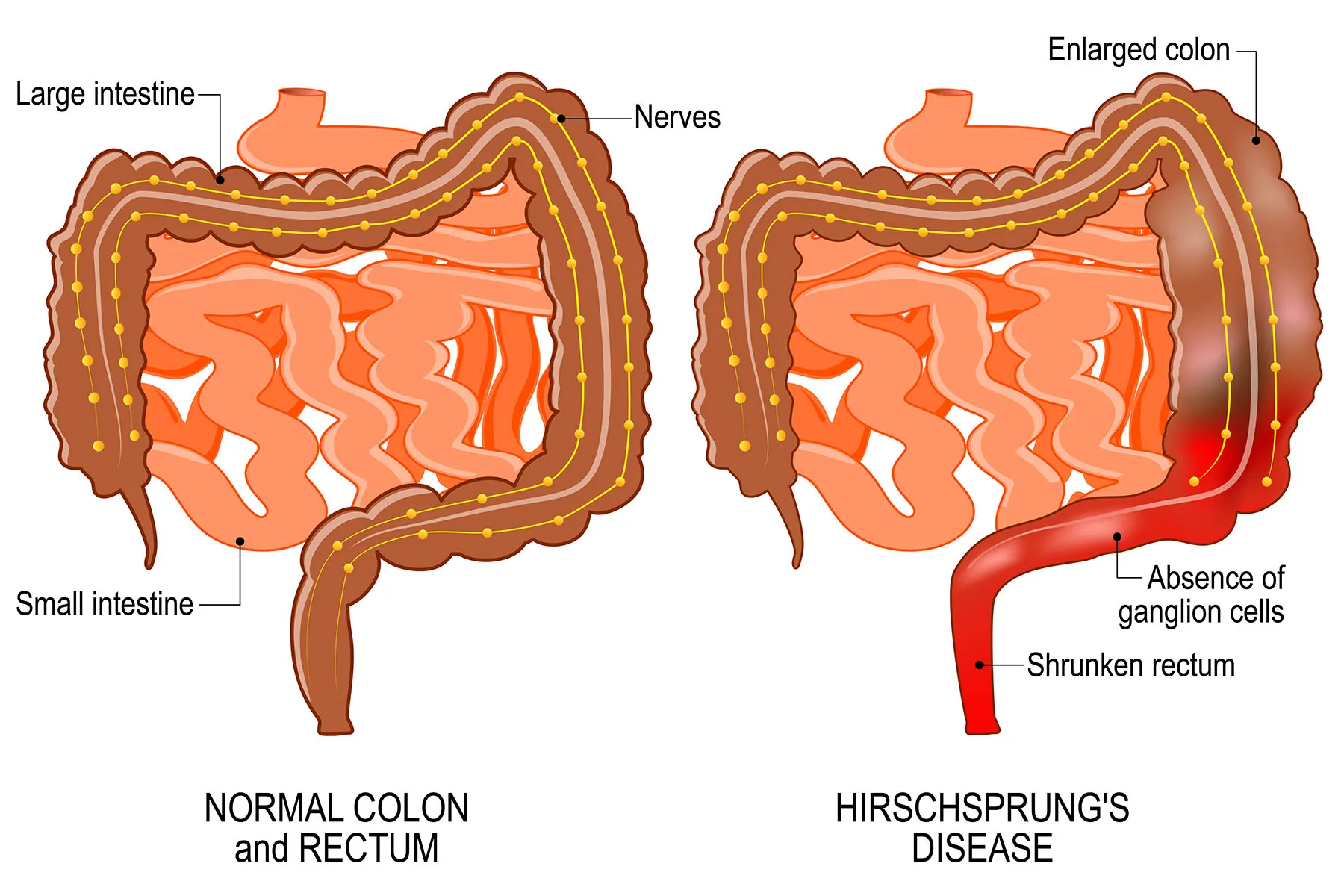 1800x1200-hirschsprungs-disease-seed.jpg