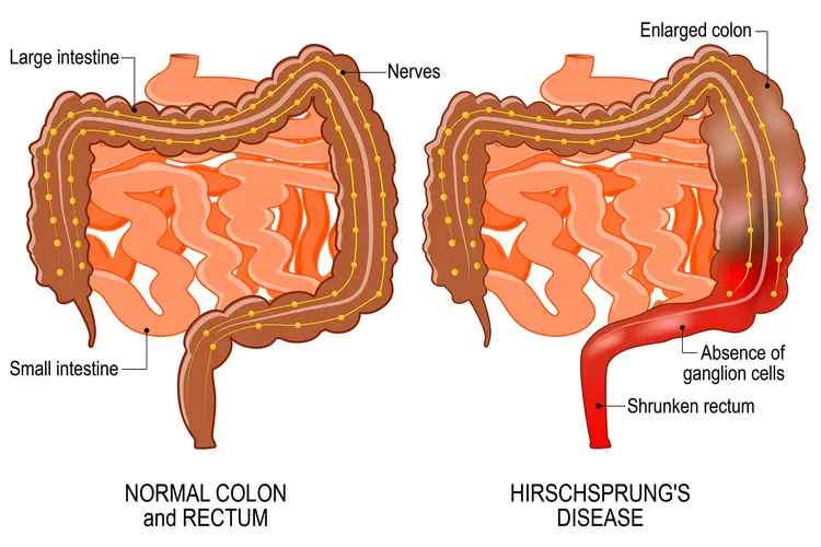 photo of hirschsprung's disease