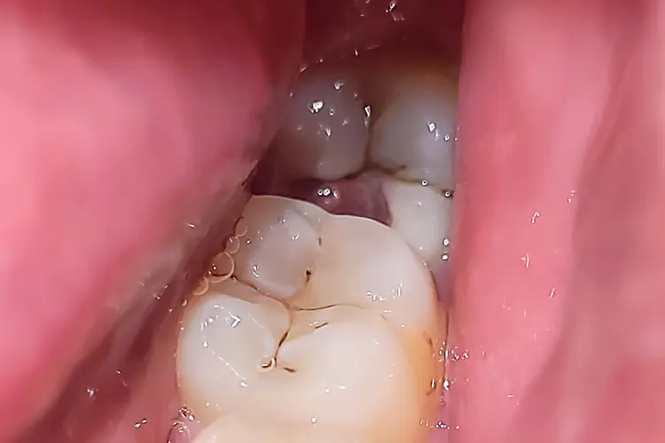 photo of pericoronitis