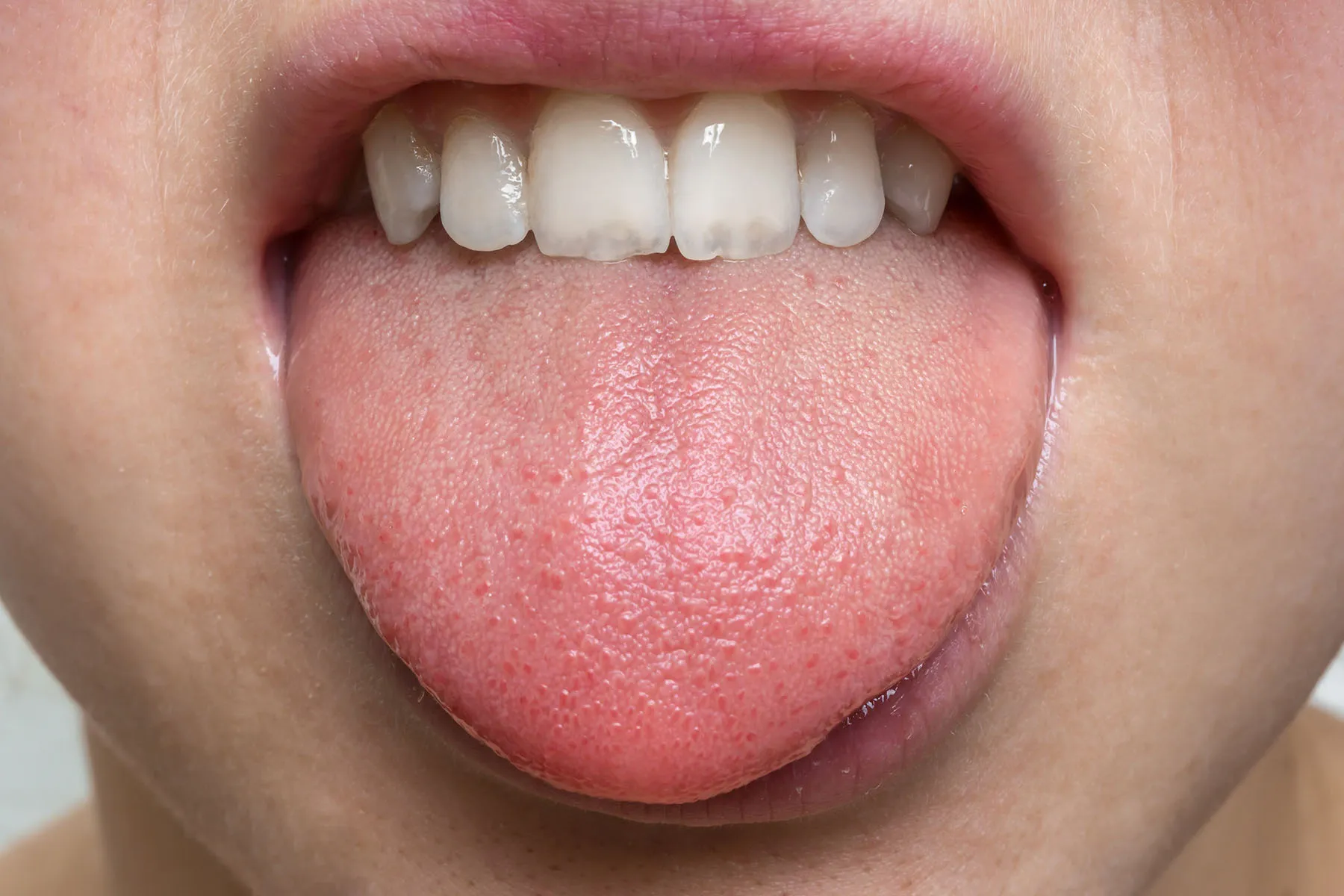 Causes of Tingling Tongue, image size:1800x1200