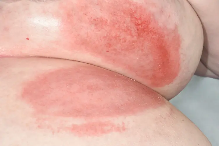 photo of intertrigo under breast