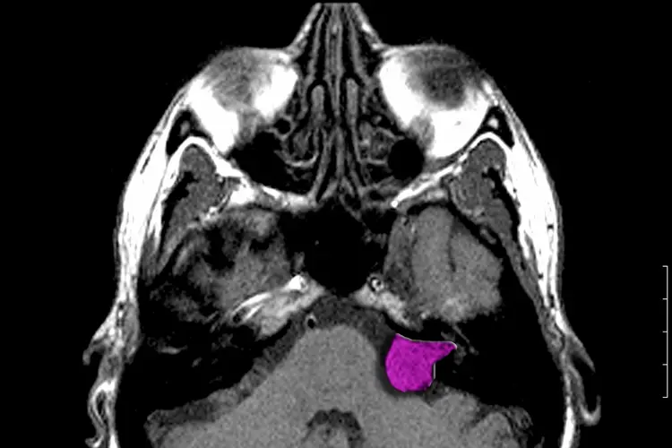 photo of schwannoma tumor