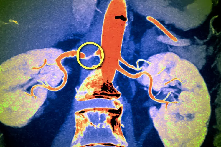 photo of renal artery stenosis