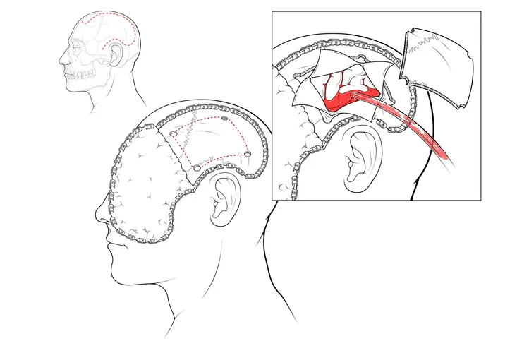 illustration of craniectomy