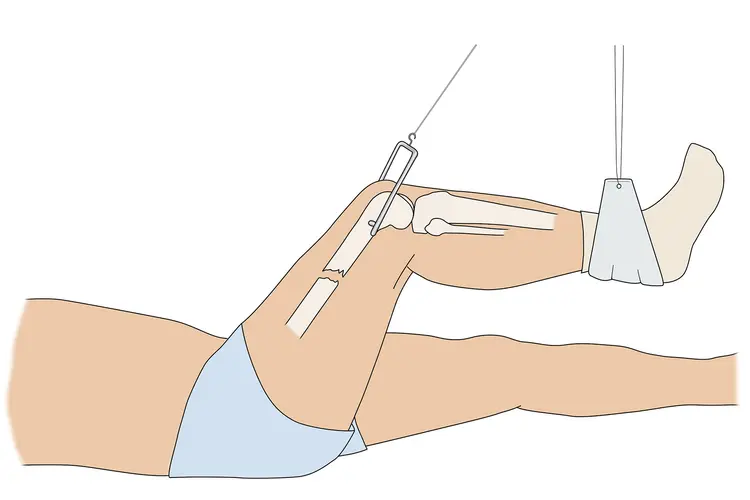 photo of skeletal traction